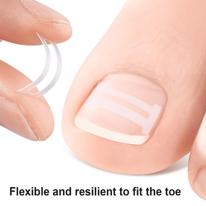 10 Pieces Ingrown Toenail Correction Kit Flexible Toenail Strips Toenail Straightener Thick Toenail Recovery for Adults