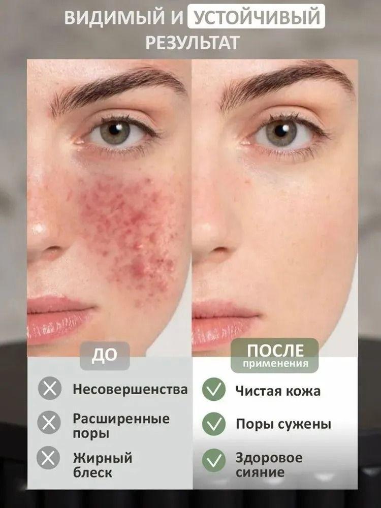 Cream for facial inflammation, acne and blackheads, for oily and problem skin, suitable for teenagers and adults, 15 g