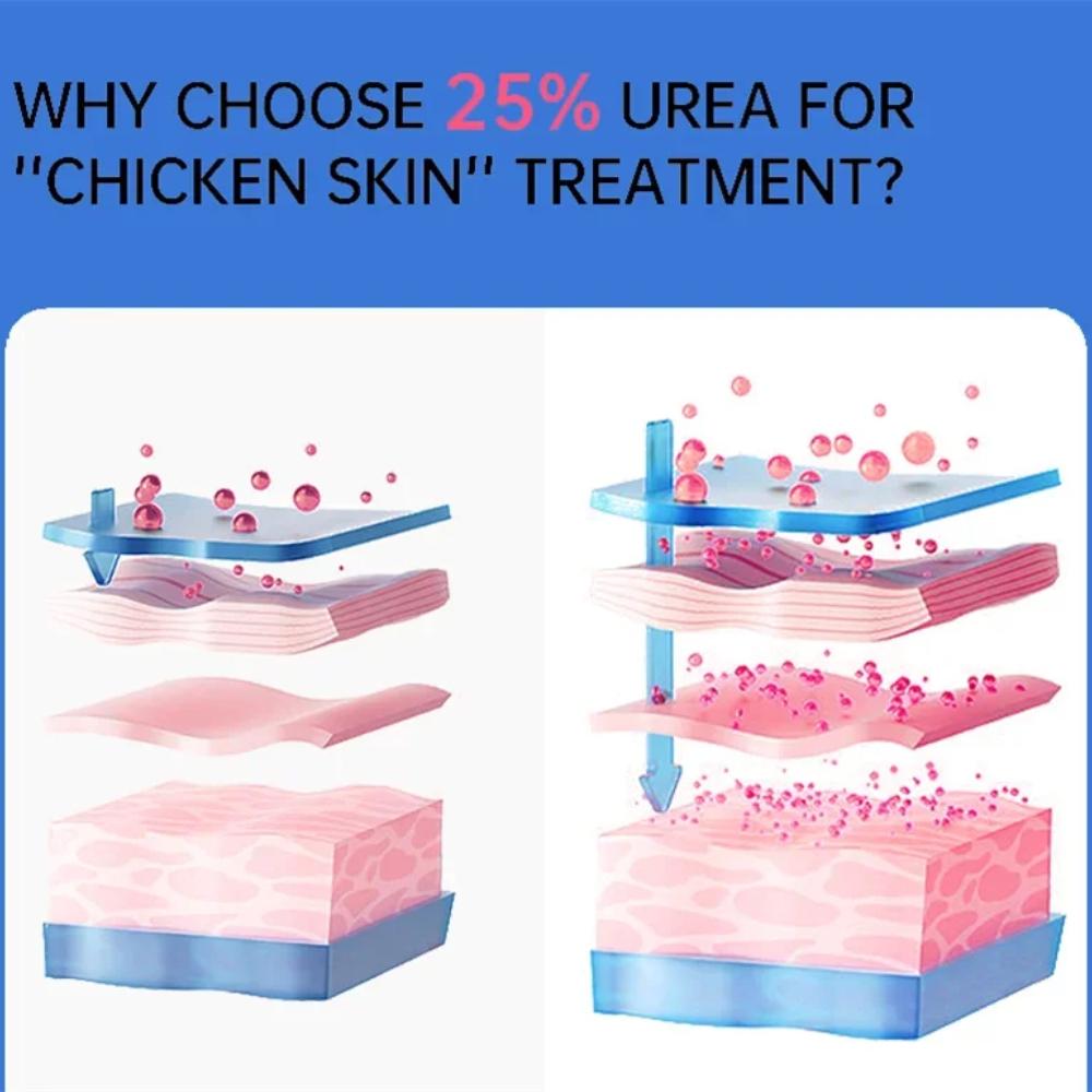 Body Whitening Cream Keratosis Pilaris Treatment Bumpy Rough Chicken Follicle Skin Repair Strawberry Legs Removal Dry Skin Care