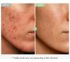 Salicylsäure Porenverfeinernde Creme 30g, Gesichts Hautglättende Creme, Poren verfeinern, Sanfte Peeling-Creme für raue & zu Unreinheiten neigende Haut