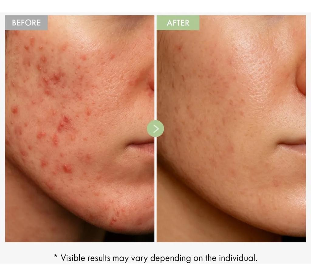 Salicylsäure Porenverfeinernde Creme 30g, Gesichts Hautglättende Creme, Poren verfeinern, Sanfte Peeling-Creme für raue & zu Unreinheiten neigende Haut