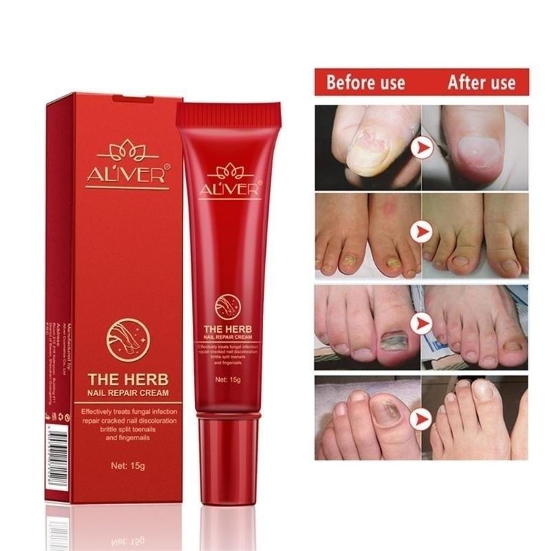 Skin Treatment Nail Foot Repair Cream Nail Fungus Dead Herb Supplies