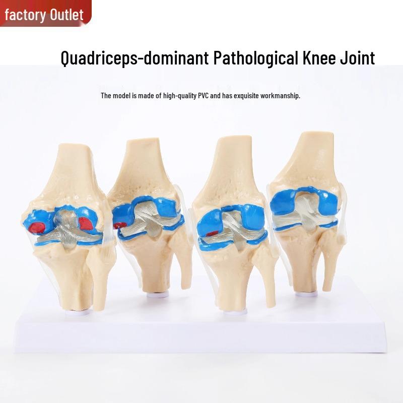 Four-Stage Pathological Human Knee Joint Model