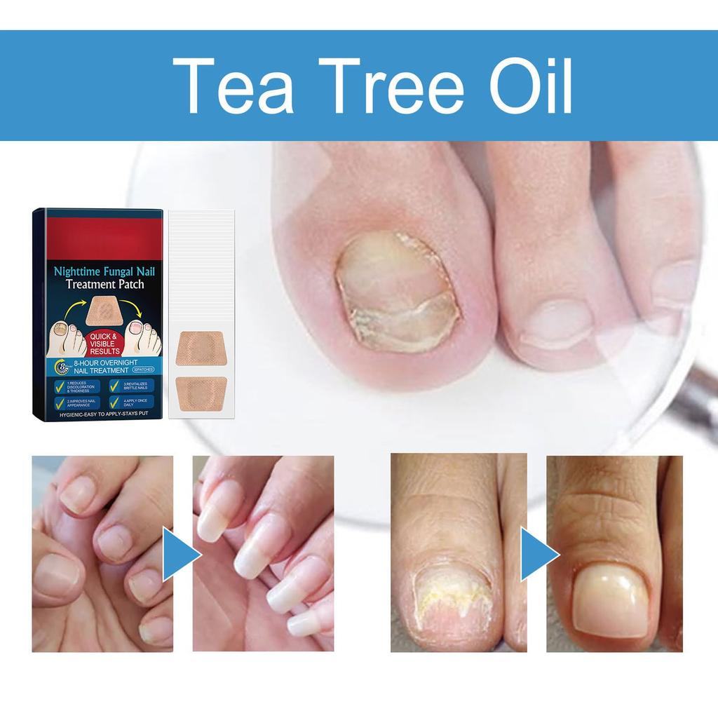 Multi-purpose Nail Care Stickers, Care For Damaged Nails, Effectively Improve The Appearance Of Damaged Fingernails And Toenails