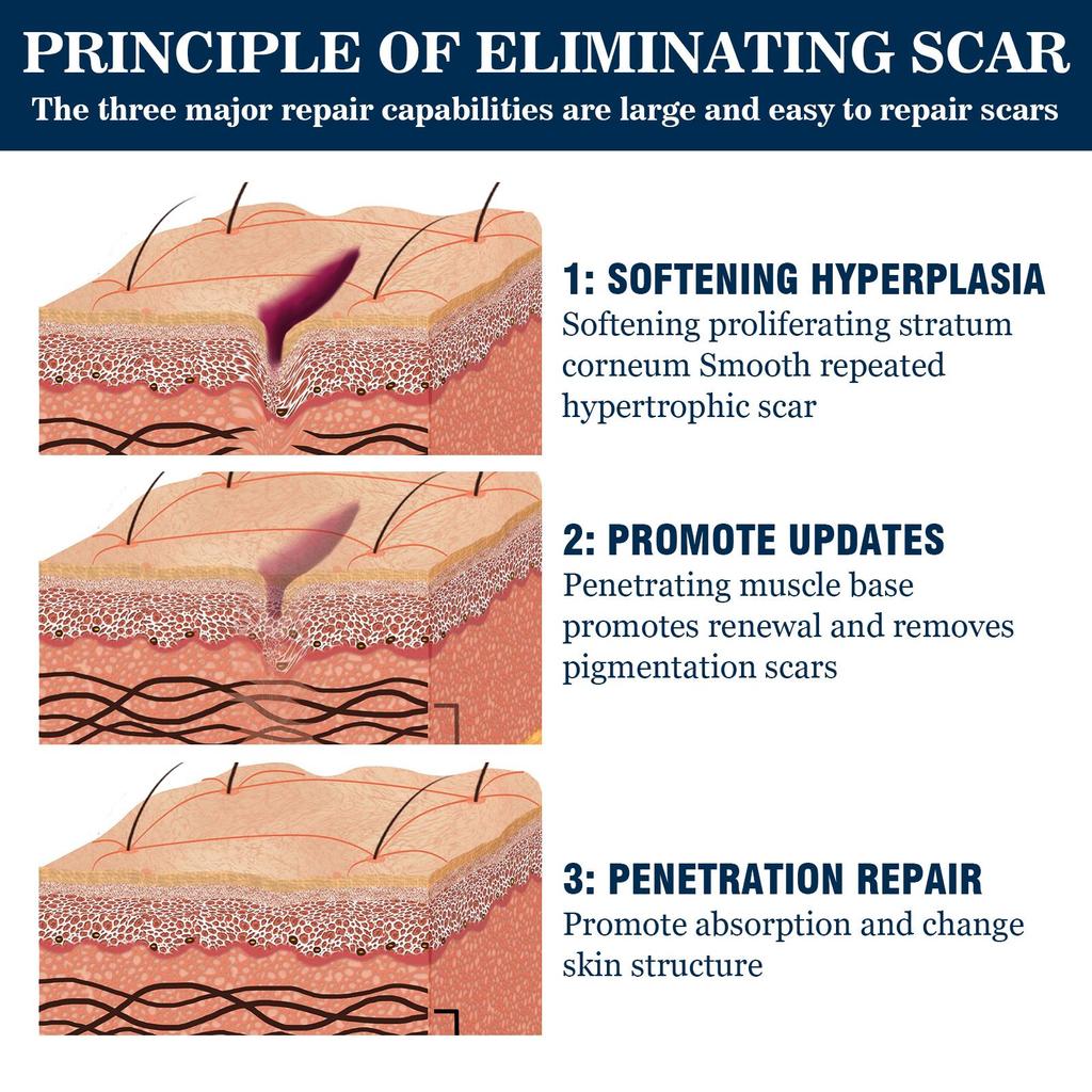 West&Month Scar Fading Gel, Post-pregnancy Stretch Mark Fading, Scar Repair and Fading, Skin Smoothing Care Gel 20g