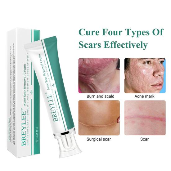 Breylee Acne Scar Removal Cream Stretch Marks Treatment Repairing Skin Care