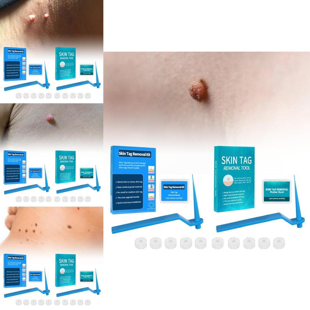 Effective Skin Tag Removal Tag Refill Band Set With 10 Pieces For Smooth Skin