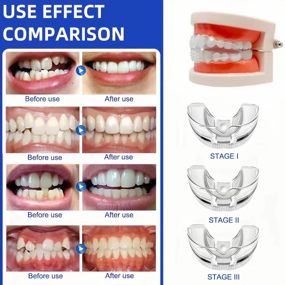 Kieferorthopädische Zahnspangen Zahnspangen Lächeln Zahnausrichtungstrainer Instanted Silikon Zahnhalter Mundschutz Zahnspangen Zahnablage
