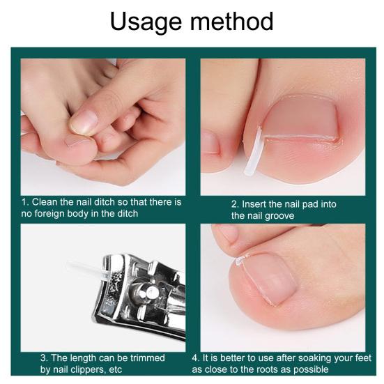 1 Set Nageleinsteller Pediküre-Werkzeug Premium Professional Eingewachsene Zehennägel Fußkorrekturaufkleber Eingewachsene Zehennägel Korrektur