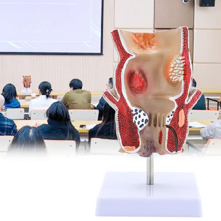 Modèle Anatomique Humain Modèle de Rectum Humain Modèle des Pathologies du Rectum Humain Support Pédagogique pour l'Éducation Scientifique