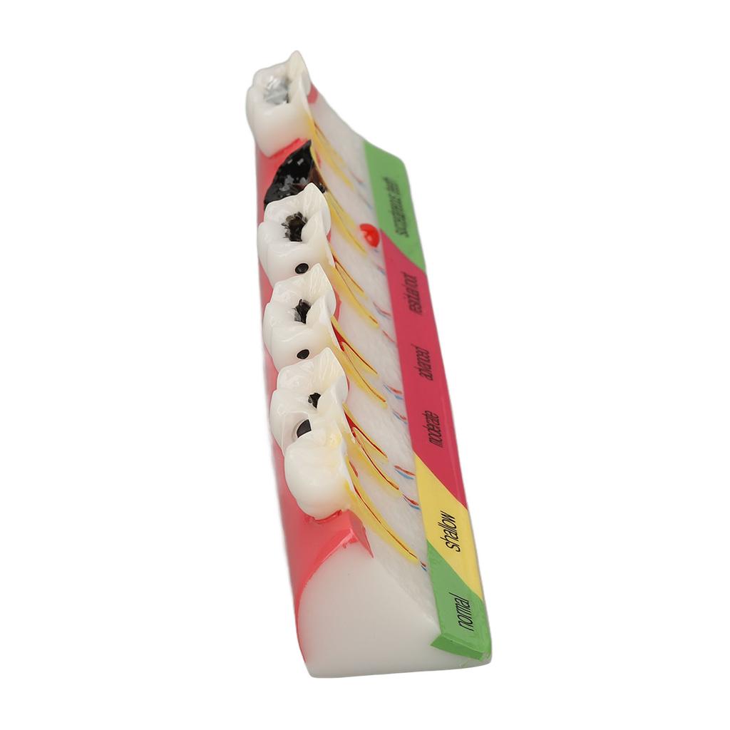 Dental Caries Model 6 Different Stages Resin Decayed Tooth Display Model