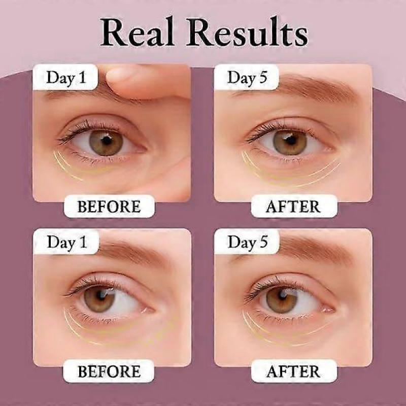 Gefriergetrocknete Augenpads, 4 Paar Augenpads, Gefrorene Augenmaske, Feuchtigkeitsspendende Augenmaske für geschwollene Augen und dunkle Ringe, Straffende Augenmaske