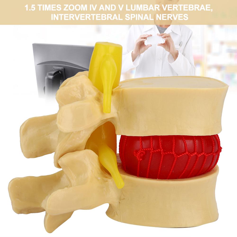 1:1.5 Lumbar Disc Herniation Demonstration Model Study Learn Human Spine
