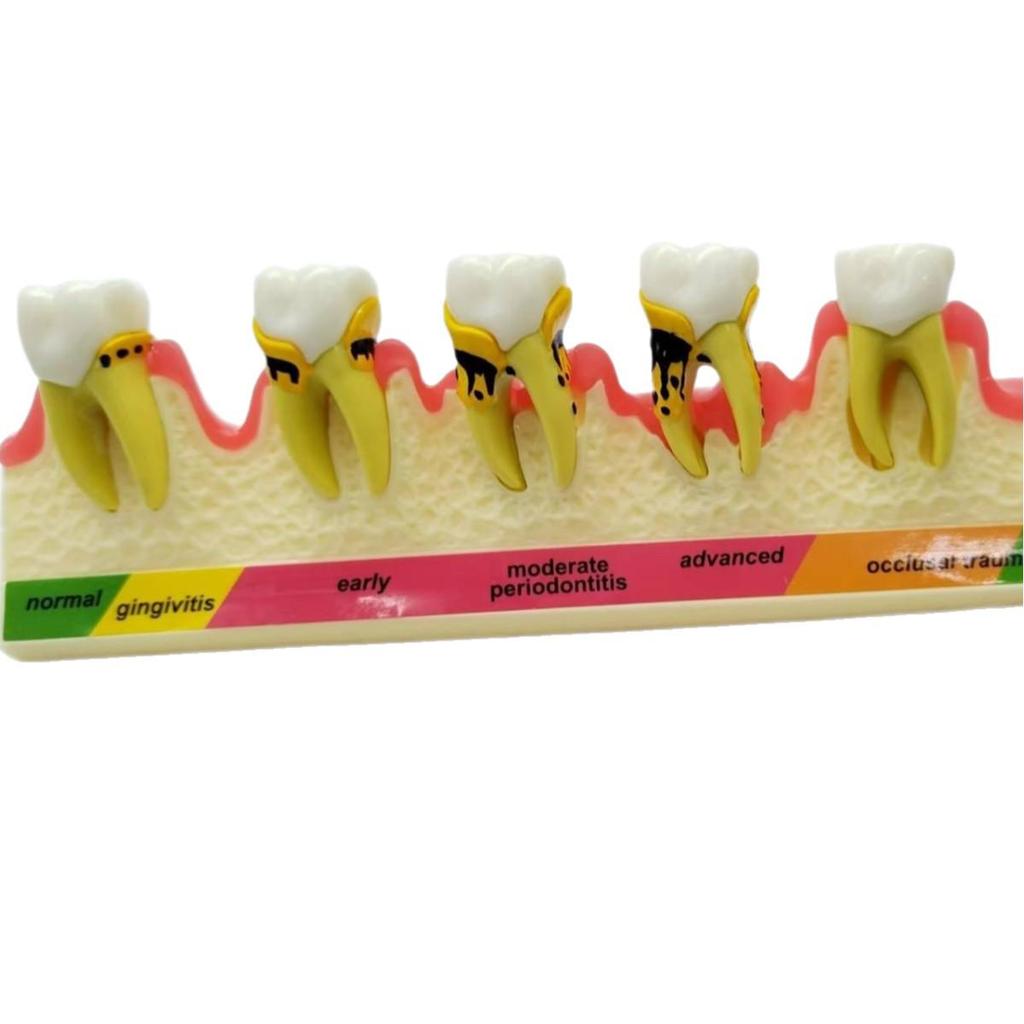 PH4010 Periodontal Classification Model: Dental Mold for Subgingival Calculus Scaling
