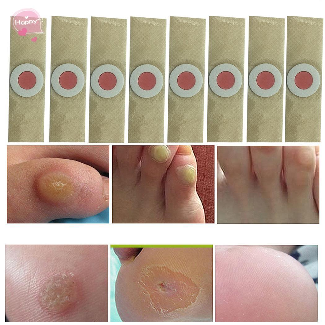 

Пластырь для удаления мозолей и натоптышей, 50 шт