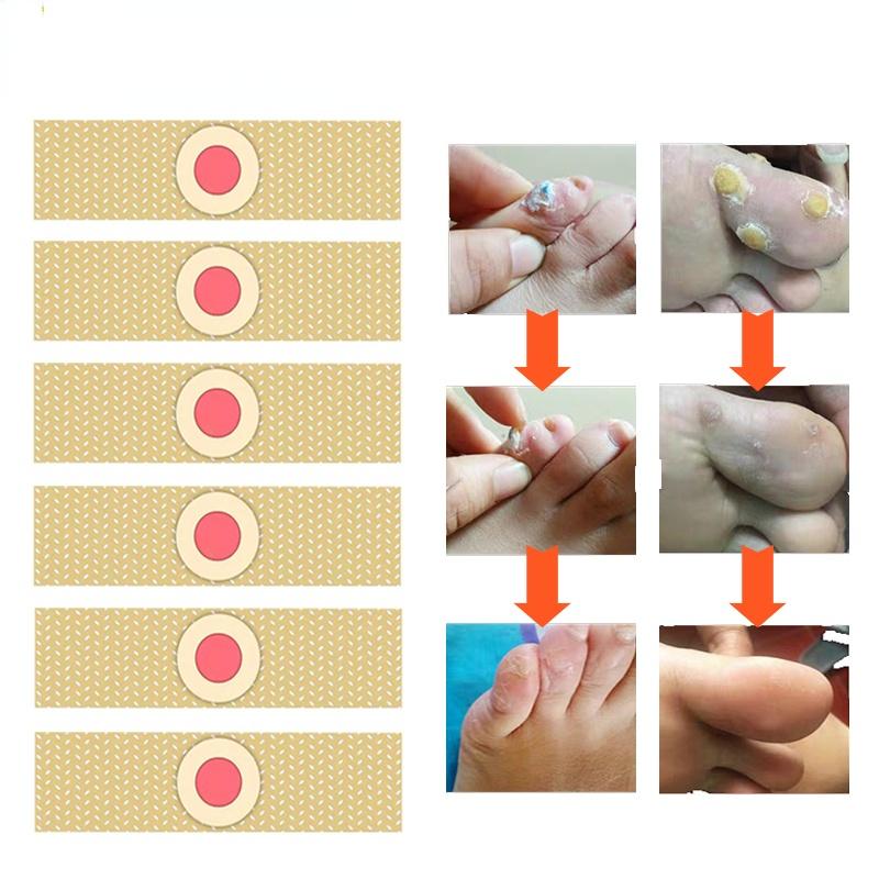 Foot Corn Removal Killer Calluses Plantar