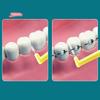 20Pcs L Type Angled Interdental Brush Soft Micro Bristles Dental Cleaning Brush for Braces Short Handle Interdental Cleaner