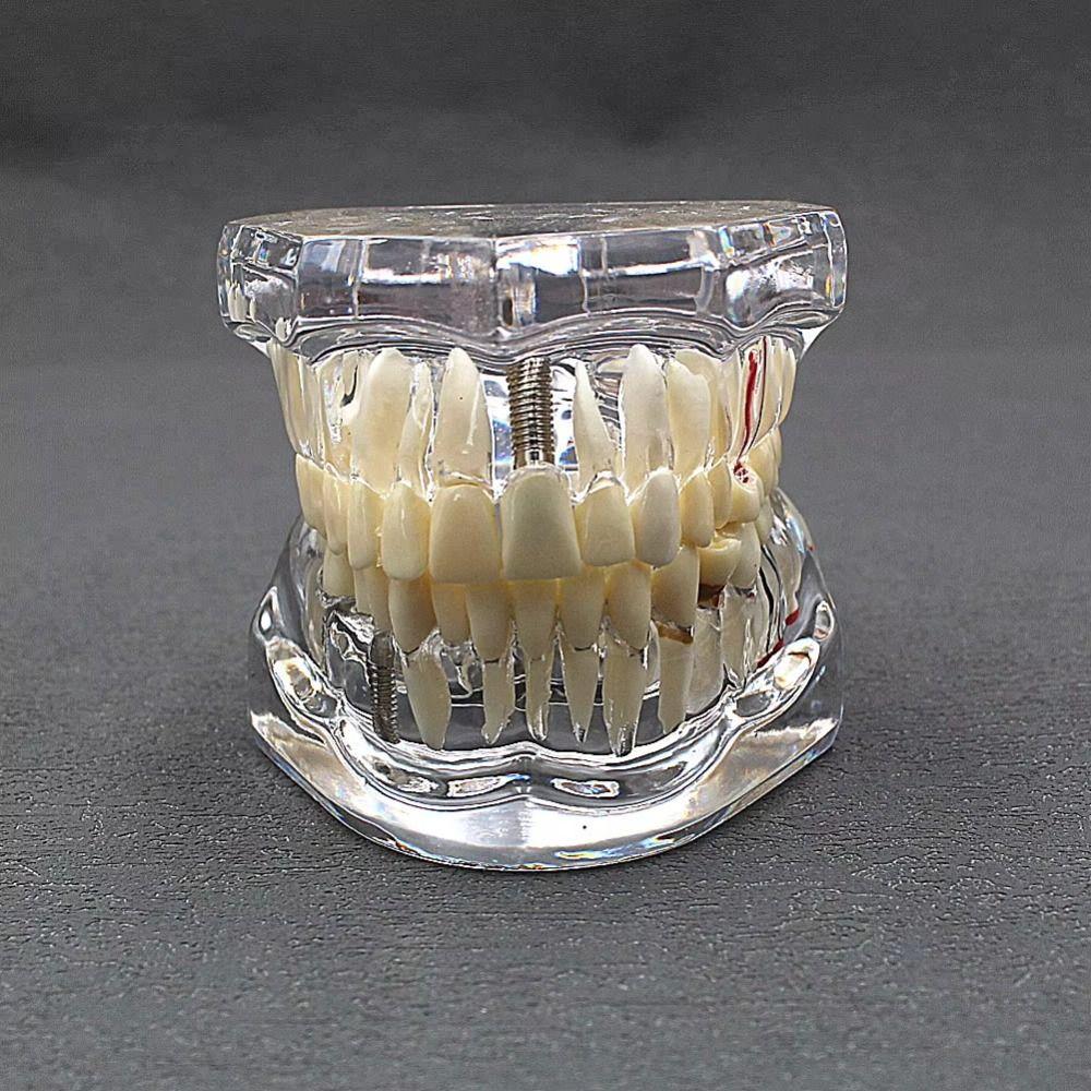 Model dentar transparent Tipuri multiple Modele standard cu implanturi Predare Stomatologie Studiu