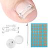 Ingrown Toenail Corrector Kit for Curved Nail Stainless Steel Armor Buckle Toe Nail Straightener Ingrown Nail Tool