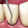 GDC Sickle Scalers Hygienist #6 (Sh6/7)