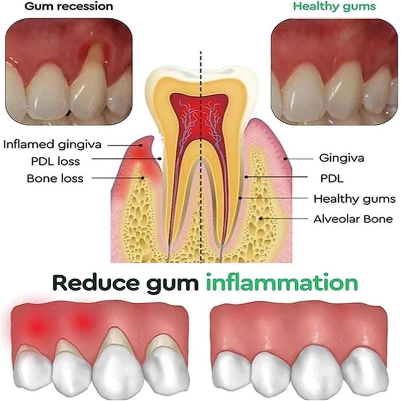 Gel Cura Riparazione Gengive Allevia Gengive Doloranti Migliora Infiammazione Gengivale Danneggiata Pulizia Macchie sui Denti Tartaro Sbiancante Gel Protettivo Gengive