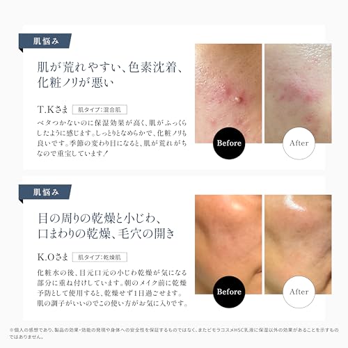 BimoRa Emulsion, Human Stem Cells and Human Ceramides, Anti-Aging Care, Moisturizing, Acne Relief, Sensitive Skin, Dry Skin, Made in Japan, 50ml