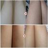 Body Whitening Cream Keratosis Pilaris Treatment Bumpy Rough Chicken Follicle Skin Repair Strawberry Legs Removal Dry Skin Care