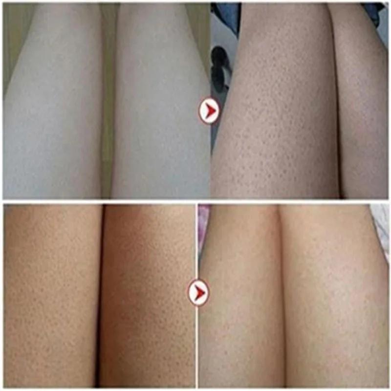 Body Whitening Cream Keratosis Pilaris Treatment Bumpy Rough Chicken Follicle Skin Repair Strawberry Legs Removal Dry Skin Care