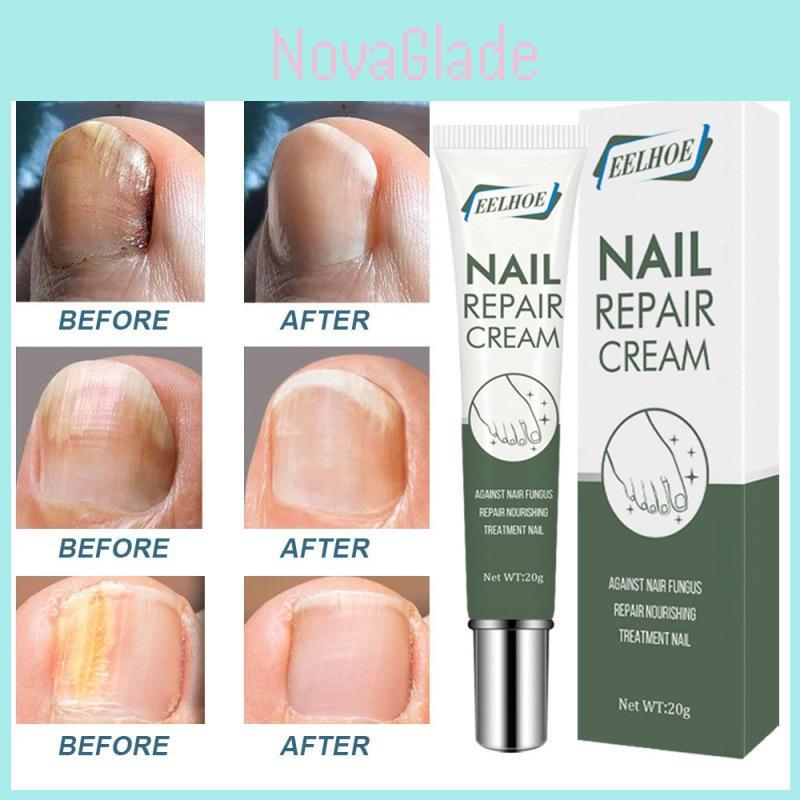 Crème de Réparation pour Ongles pour des Ongles Sains et Forts et Soin Doux des Pieds 20g Pour le Traitement des Ongles Endommagés