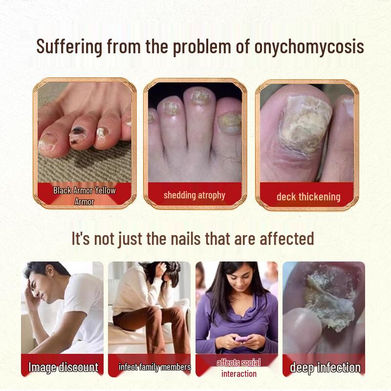Onychomycosis Treatment Foot Soak Pack