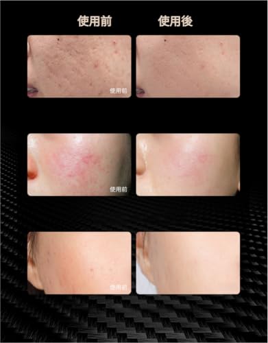 Derlights LED Facial Mask, Red Light Mask with 7 Colors of LED Light, Skin Care, Face Care, Timer Function, Women's Skin Treatment Mask, Near-Infrared