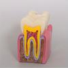 6x Model zubního kazu Nemoc Zuby Zubní model pro zubní demonstraci Model Zubař Výuka Zubní laboratoř Orální výzkum
