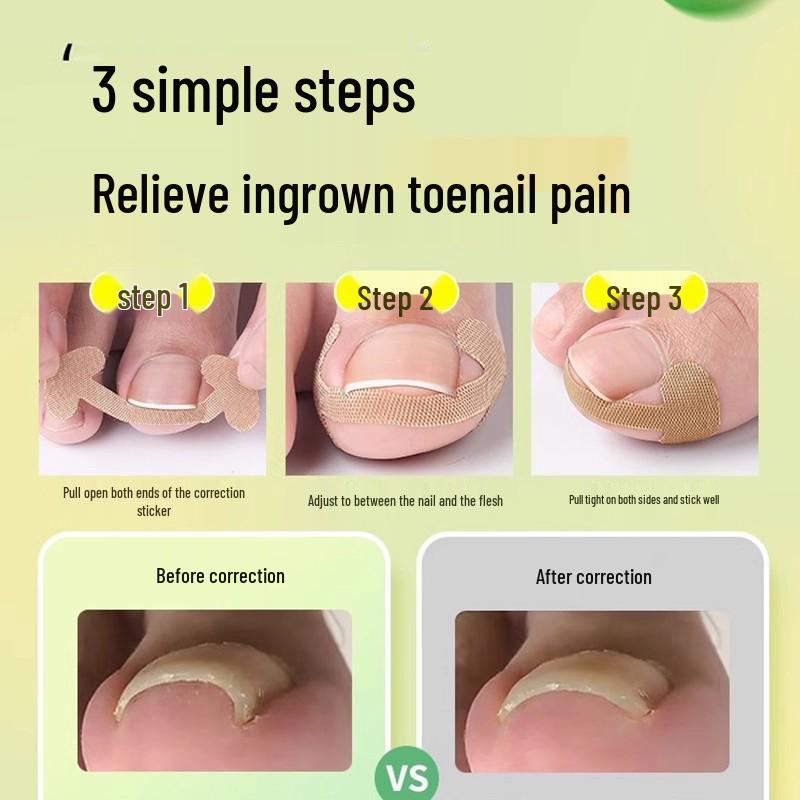 Glue-Free Natural Ingrown Toenail Corrector Stickers