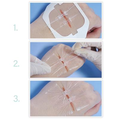 Butterfly Zipstitch Laceration Zipper Band Aids Zip Stitch Sutures Emergency Wound Closures Device Painless Zip Stitch