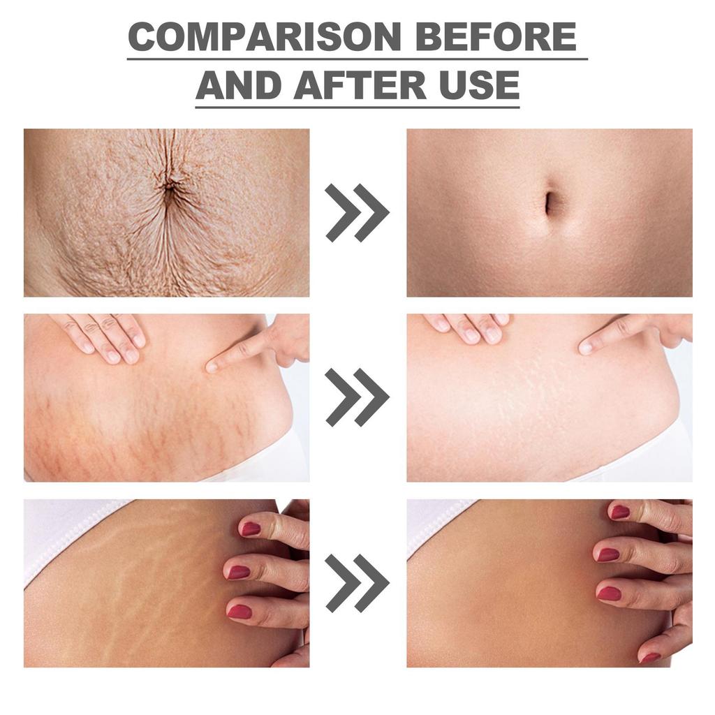 Wiieey Butter Moisturizing Cream Lightens Stretch Marks Repairs Skin Elasticity Firms & Smoothes