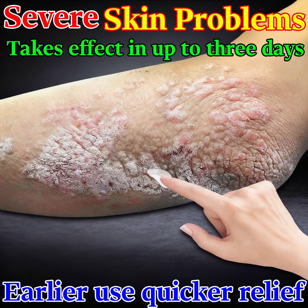 Natural Dermatitis Relief Gel - Eases Eczema & Skin Problems, Gentle for Sensitive Skin