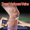 Varicose Veins
