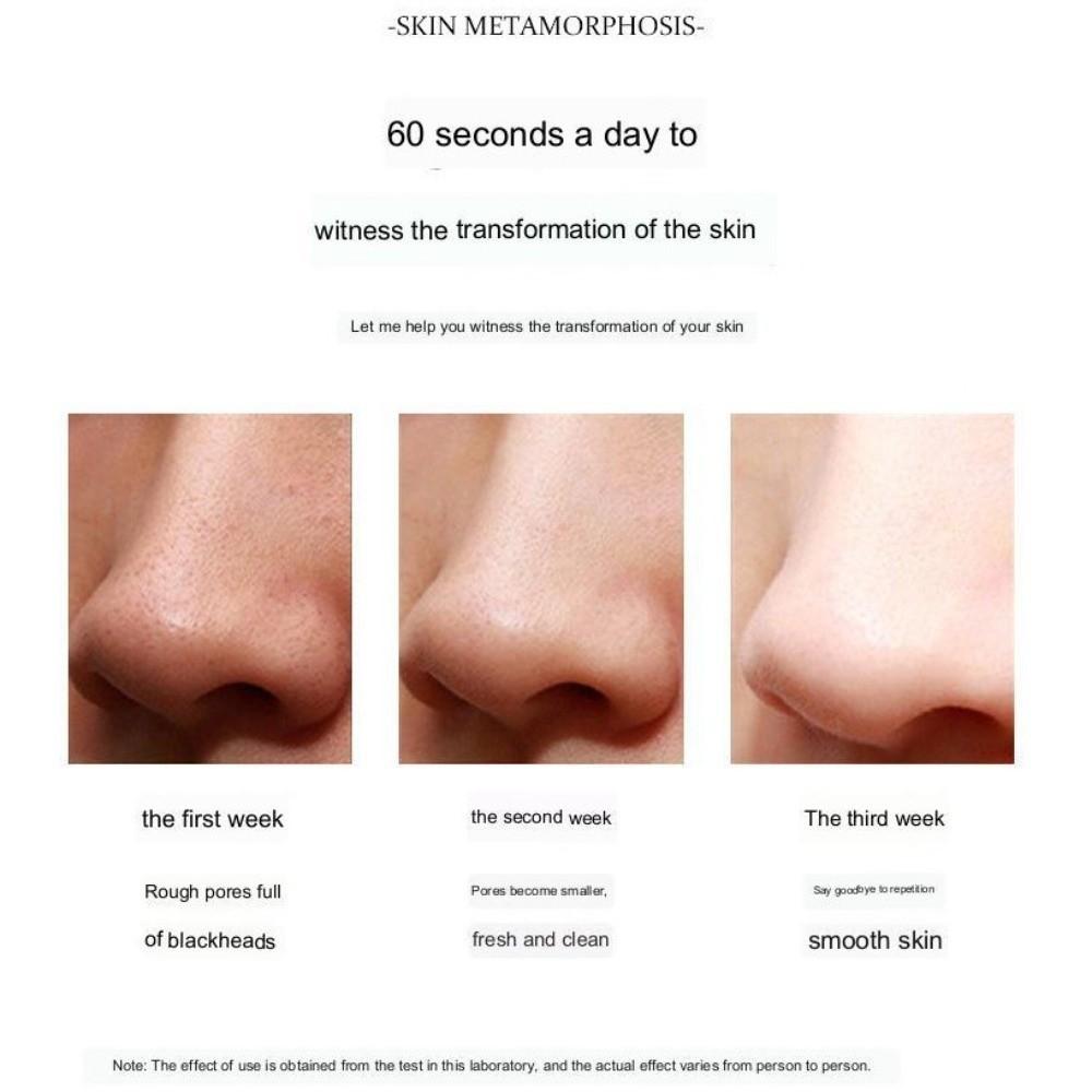 Visual Facial Blackhead Removal Instrument Pore Cleanser Blackhead Sucker  Skin Care