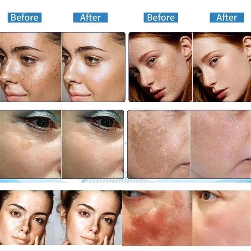Powerful Spot-Removing Whiten Cream Brighten Skin Fast Eliminates Melanin Pigmentation Melasma Dark Spots