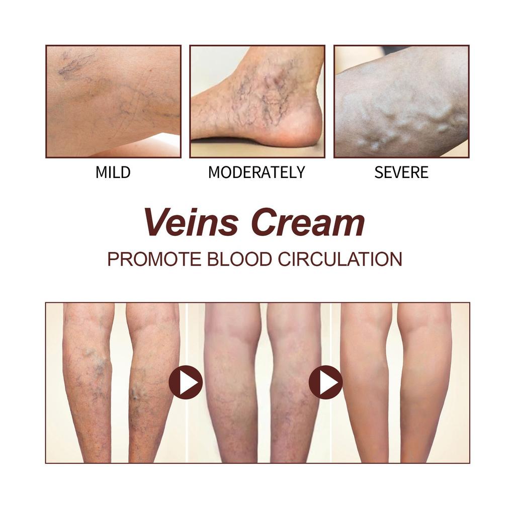 Vein Care Fading Paste -Anti Varicose Vein Soothing Leg Paste,  The Appearance Of Varicose Veins