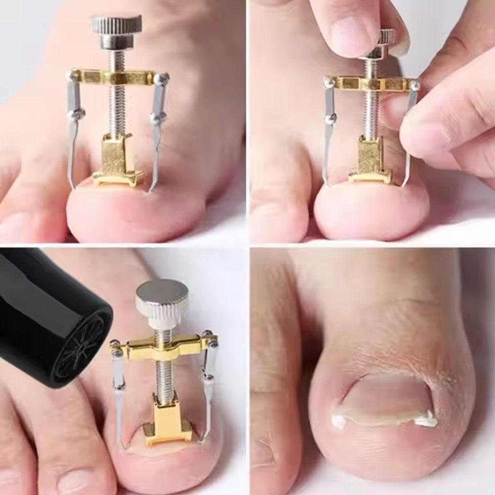 1/3/5PC Ingrown Toenail Corrector Straightening Clip Pedicure Foot Nail Care Tools Stainless Steel Pedicure Treatment Correction