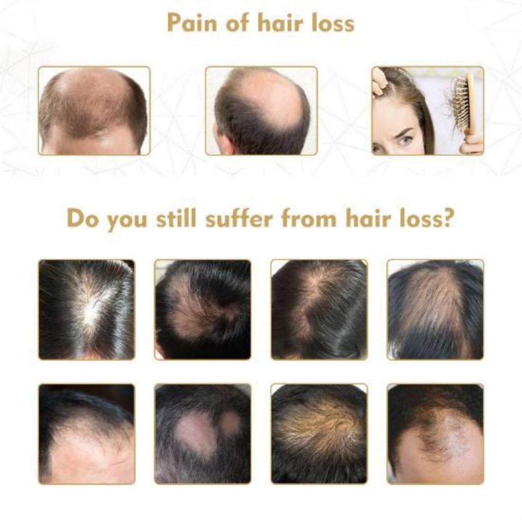 Anti-Alopezie-Haarwachstumsserum, ätherisches Öl, Anti-Haarausfall-Spray-Produkte, Ingwer-Behandlung, trockenes, krauses, beschädigtes Haar