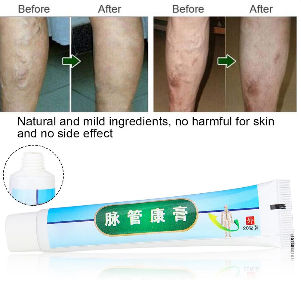 Varicose Vascular Inflammation Massage Cream Treatment Varicose Vein Ointment