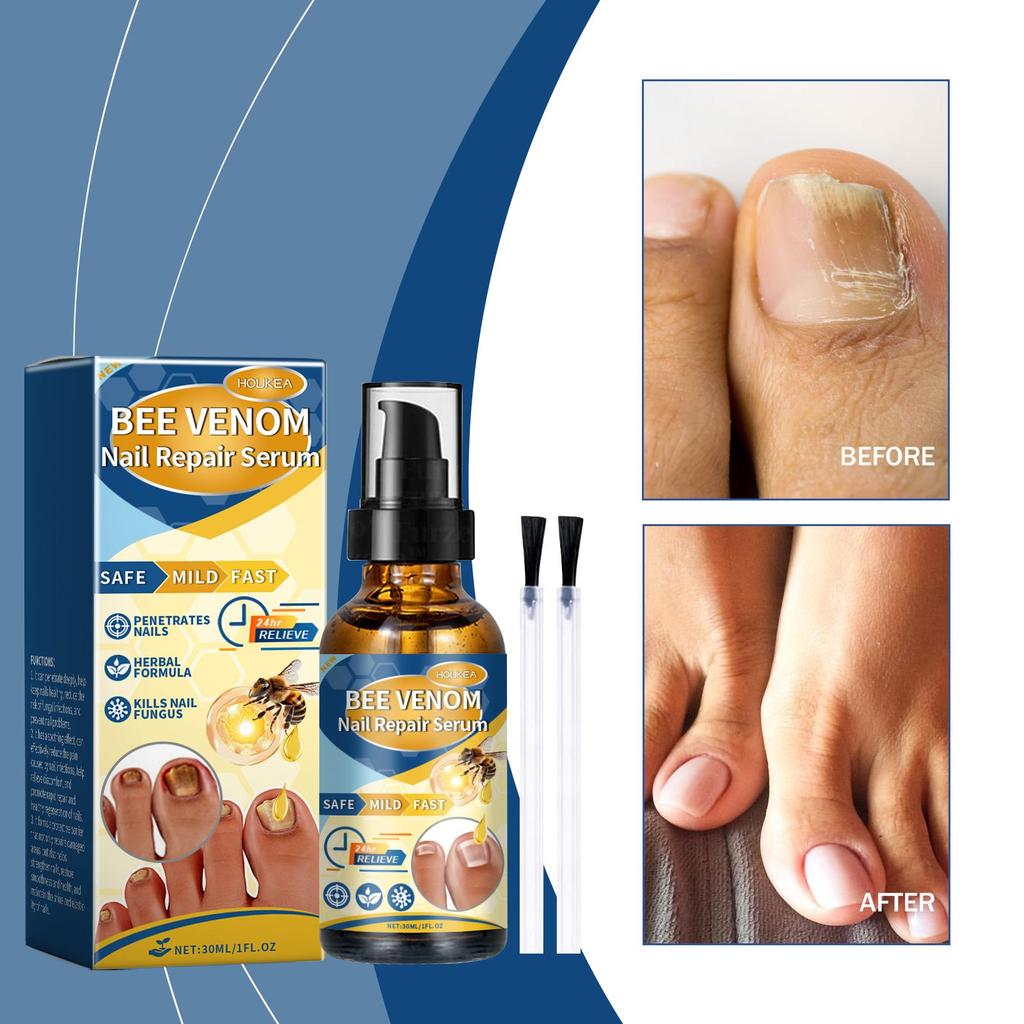 Nail Fungus Treatment Serum Spray Repair Dryness Cracking Infection Fungal Nail Remove Inflammation Swelling Foot Care Products