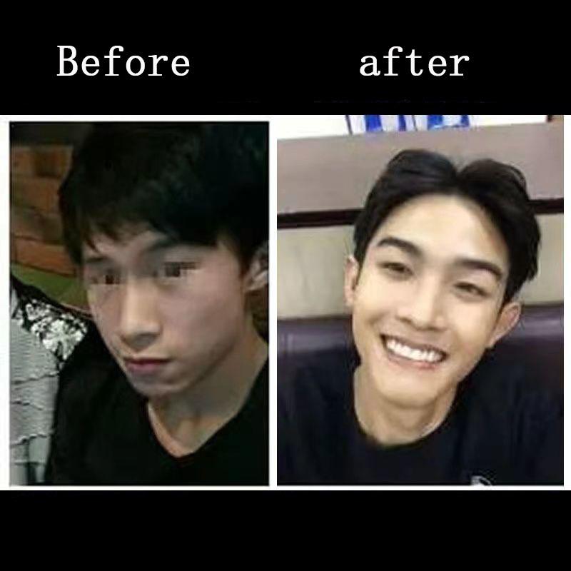 Buy 9D Dental Braces Invisible Transparent Braces Correction Buck Teeth