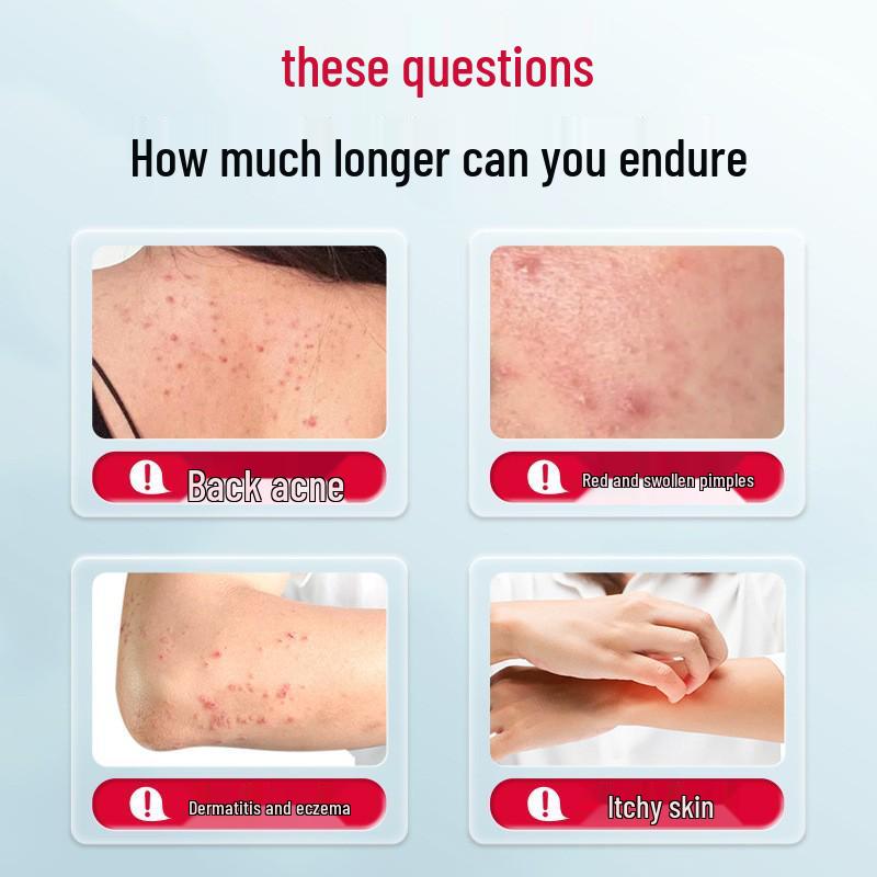 Changbai Mountain Skin Spray for Eczema, Dermatitis, Acne, Itching, and Non-Chronic Wound Care.