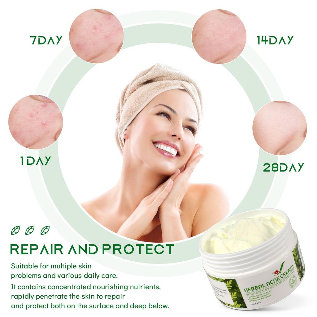 Herbal Acne Creams Anti-Pimple Creams Anti-Acne Creams Acne Balance Water And Oil Skin Blemishes Effective For Body And Face 50g