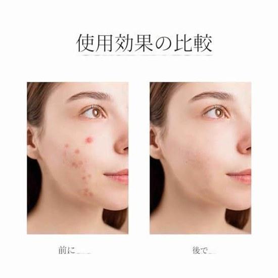 Acne Patch Hydrocolloid That Covers Face Invisible Spot Suitable All Skin Types (150 Pieces)