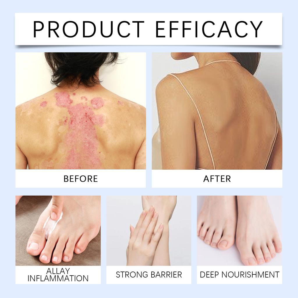 Foot Care Cream Promotes Skin Care. The Debridement Cream Gently Nourishes And Improves Dry Feet.