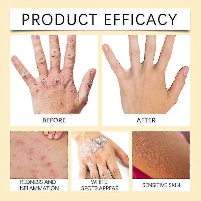 Vitiligo Treatments Cream Portable Anti-itch Body Care Cream for Skin Care